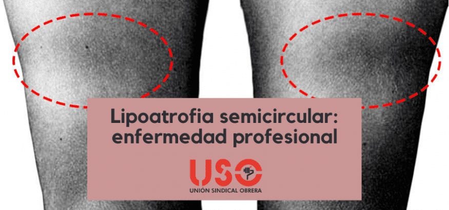 Lipoatrofia semicircular, enfermedad profesional en edificios modernos